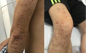 Bỗng nhiên nổi dày đặc nốt trên da, sụt cân không phanh, phát hiện u phát ban Bỗng nhiên nổi dày đặc nốt trên da, sụt cân không phanh, phát hiện u phát ban