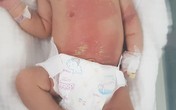 Con 2 tuần tuổi chướng bụng, mẹ chữa theo cách này khiến con bỏng nặng Con 2 tuần tuổi chướng bụng, mẹ chữa theo cách này khiến con bỏng nặng