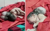 Trẻ sơ sinh 3 đầu như "người ngoài hành tinh" khiến các bác sĩ choáng váng Trẻ sơ sinh 3 đầu như "người ngoài hành tinh" khiến các bác sĩ choáng váng