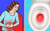 Đi tiểu thấy có dấu hiệu này, cẩn thận tín hiệu cảnh báo ung thư, hãy nhanh đi khám ngay Đi tiểu thấy có dấu hiệu này, cẩn thận tín hiệu cảnh báo ung thư, hãy nhanh đi khám ngay