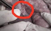 Que tăm nhọn hoắt đâm xuyên dạ dày, gan, màng tim nam thanh niên Que tăm nhọn hoắt đâm xuyên dạ dày, gan, màng tim nam thanh niên