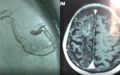Người đàn ông đau đầu 30 năm, bác sĩ lôi ra sinh vật 10cm trong não Người đàn ông đau đầu 30 năm, bác sĩ lôi ra sinh vật 10cm trong não