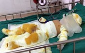 Thương tâm bé trai 7 tháng tuổi cùng cha mẹ bị bỏng nặng do hở gas lúc đun nấu Thương tâm bé trai 7 tháng tuổi cùng cha mẹ bị bỏng nặng do hở gas lúc đun nấu