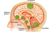 Những dấu hiệu u não hay gặp, điều thứ 3 nhiều người mắc mà không biết Những dấu hiệu u não hay gặp, điều thứ 3 nhiều người mắc mà không biết