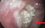 Người đàn ông bị sùi mào gà vì thường xuyên đi lấy ráy tai: Cảnh báo những thói quen tai hại dễ rước bệnh vào người Người đàn ông bị sùi mào gà vì thường xuyên đi lấy ráy tai: Cảnh báo những thói quen tai hại dễ rước bệnh vào người