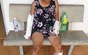 Bình Thuận: Vợ bị chồng đánh gãy 2 tay 1 chân Bình Thuận: Vợ bị chồng đánh gãy 2 tay 1 chân