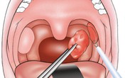 Cảnh báo những rủi ro có thể gặp phải khi cắt amidan Cảnh báo những rủi ro có thể gặp phải khi cắt amidan