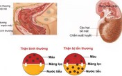 Người già bị cao huyết áp có thể suy thận bất cứ lúc nào Người già bị cao huyết áp có thể suy thận bất cứ lúc nào