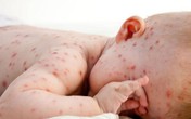 Vì sao cốm Subạc được coi là “cứu tinh” cho người mắc bệnh ngoài da do virus? Vì sao cốm Subạc được coi là “cứu tinh” cho người mắc bệnh ngoài da do virus?