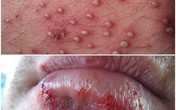 Các bệnh ngoài da do virus là gì và cách điều trị hiệu quả như thế nào? Các bệnh ngoài da do virus là gì và cách điều trị hiệu quả như thế nào?
