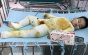Xót xa bé trai 2 tuổi bị bỏng toàn thân do ngã vào nồi nước nóng Xót xa bé trai 2 tuổi bị bỏng toàn thân do ngã vào nồi nước nóng