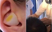 Nhét tỏi vào lỗ tai để trị đau tai gây mất ngủ, người đàn ông phải nhận kết đắng Nhét tỏi vào lỗ tai để trị đau tai gây mất ngủ, người đàn ông phải nhận kết đắng