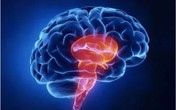 Thói quen trong quan hệ tình dục khiến cô gái 24 tuổi bị nhồi máu não Thói quen trong quan hệ tình dục khiến cô gái 24 tuổi bị nhồi máu não