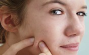 Nhiễm trùng huyết vì nặn mụn, việc nhỏ nhưng lại gây họa lớn
