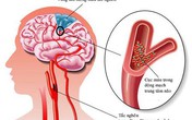 Sai lầm nhiều người mắc khi sơ cứu người bị đột quỵ khiến bệnh trầm trọng hơn Sai lầm nhiều người mắc khi sơ cứu người bị đột quỵ khiến bệnh trầm trọng hơn