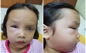Bé gái suýt chết vì sâu răng, nha sĩ trách cha mẹ hại con vì thói quen tai hại Bé gái suýt chết vì sâu răng, nha sĩ trách cha mẹ hại con vì thói quen tai hại
