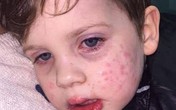 Bé trai 3 tuổi nhiễm virus bệnh tình dục sau nụ hôn vào má Bé trai 3 tuổi nhiễm virus bệnh tình dục sau nụ hôn vào má