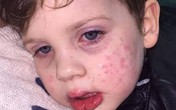 Bé trai 3 tuổi nhiễm virus bệnh tình dục sau nụ hôn vào má Bé trai 3 tuổi nhiễm virus bệnh tình dục sau nụ hôn vào má