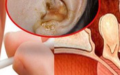 Trả giá đắt: Suýt viêm màng não vì cái bông tăm Trả giá đắt: Suýt viêm màng não vì cái bông tăm
