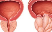 Nam giới xuất hiện 4 dấu hiệu này, có thể là tuyến tiền liệt đang "kêu cứu" Nam giới xuất hiện 4 dấu hiệu này, có thể là tuyến tiền liệt đang "kêu cứu"