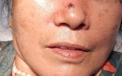 Nốt ruồi trên sống mũi bỗng "hoá" thành ung thư: Cách phân biệt nốt ruồi và ung thư Nốt ruồi trên sống mũi bỗng "hoá" thành ung thư: Cách phân biệt nốt ruồi và ung thư