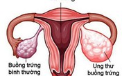 Nhiều trẻ chưa 15 tuổi đã mắc ung thư buồng trứng, đừng chủ quan khi thấy dấu hiệu này Nhiều trẻ chưa 15 tuổi đã mắc ung thư buồng trứng, đừng chủ quan khi thấy dấu hiệu này