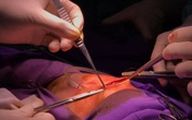 Bé 1 ngày tuổi có triệu chứng 'sùi bọt cua' được kịp thời cứu sống Bé 1 ngày tuổi có triệu chứng 'sùi bọt cua' được kịp thời cứu sống