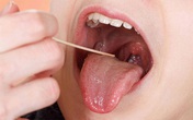 Ung thư lưỡi ngày càng phổ biến, bác sĩ cảnh báo 4 nguyên nhân gây bệnh Ung thư lưỡi ngày càng phổ biến, bác sĩ cảnh báo 4 nguyên nhân gây bệnh