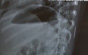 Tìm ra "thủ phạm" khiến bé gái sốt cao kéo dài không ai nghĩ tới Tìm ra "thủ phạm" khiến bé gái sốt cao kéo dài không ai nghĩ tới