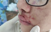 TPHCM: Cô gái trẻ sưng phù mặt khi tiêm filler làm đẹp TPHCM: Cô gái trẻ sưng phù mặt khi tiêm filler làm đẹp