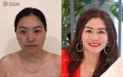 Ghép mỡ mặt tự thân – tạo dáng khuôn mặt chuẩn tỷ lệ vàng không phẫu thuật Ghép mỡ mặt tự thân – tạo dáng khuôn mặt chuẩn tỷ lệ vàng không phẫu thuật