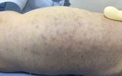 Bé sơ sinh tử vong do nhiễm virus CMV Bé sơ sinh tử vong do nhiễm virus CMV