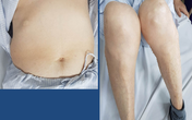 Tháng sụt 7kg nhưng bụng béo ra, người phụ nữ không ngờ mắc loại bệnh do thói quen hàng ngày Tháng sụt 7kg nhưng bụng béo ra, người phụ nữ không ngờ mắc loại bệnh do thói quen hàng ngày