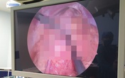Ruột non nằm trên khoang màng phổi Ruột non nằm trên khoang màng phổi