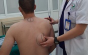 Uống nhiều rượu, cơ thể nam bệnh nhân biến đổi với những khối u lớn ở lưng Uống nhiều rượu, cơ thể nam bệnh nhân biến đổi với những khối u lớn ở lưng