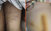 Bé gái 4 tuổi bị bố bạo hành đến mức vỡ ruột, nhập viện trong tình trạng nguy kịch, lời kể của những người trong cuộc gây hoang mang Bé gái 4 tuổi bị bố bạo hành đến mức vỡ ruột, nhập viện trong tình trạng nguy kịch, lời kể của những người trong cuộc gây hoang mang