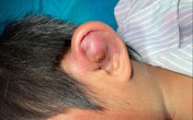 Cứu bé trai ở vùng lũ bị viêm sụn vành tai Cứu bé trai ở vùng lũ bị viêm sụn vành tai