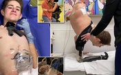 Sống sót kỳ diệu sau khi bị xe 4 tấn đè, phẫu thuật cắt mất nửa thân dưới Sống sót kỳ diệu sau khi bị xe 4 tấn đè, phẫu thuật cắt mất nửa thân dưới