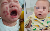 Bé trai khoẻ mạnh bỗng xuất huyết tím đen khắp người, ai ngờ mắc bệnh rất hiếm, thế giới chỉ 300 người bị Bé trai khoẻ mạnh bỗng xuất huyết tím đen khắp người, ai ngờ mắc bệnh rất hiếm, thế giới chỉ 300 người bị
