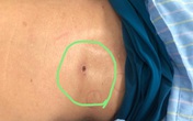 Người đàn ông suy đa tạng sau khi bị mò đốt Người đàn ông suy đa tạng sau khi bị mò đốt