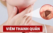 Tại sao hàng triệu người bị khản tiếng tin dùng Tiêu Khiết Thanh hỗ trợ điều trị hơn 10 năm qua? Tại sao hàng triệu người bị khản tiếng tin dùng Tiêu Khiết Thanh hỗ trợ điều trị hơn 10 năm qua?