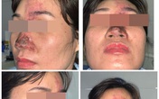 Tiêm filler làm đẹp, nữ bệnh nhân mưng mủ ở mũi, suýt mù mắt Tiêm filler làm đẹp, nữ bệnh nhân mưng mủ ở mũi, suýt mù mắt