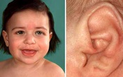 Đôi tai tiết lộ về sức khỏe của bạn Đôi tai tiết lộ về sức khỏe của bạn