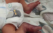 Đau đớn, bé sơ sinh gãy chân vì mẹ sinh con ở nhà Đau đớn, bé sơ sinh gãy chân vì mẹ sinh con ở nhà