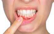 Cảnh báo: Những người bị chảy máu nướu răng có nguy cơ đột quỵ não cao gấp 2 lần người bình thường Cảnh báo: Những người bị chảy máu nướu răng có nguy cơ đột quỵ não cao gấp 2 lần người bình thường