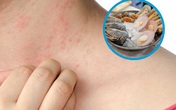 Ham hải sản giá rẻ, nguy kịch vì dị ứng Ham hải sản giá rẻ, nguy kịch vì dị ứng