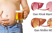 Dấu hiệu người bị gan nhiễm mỡ phải cảnh giác, đặc biệt là sau Tết Dấu hiệu người bị gan nhiễm mỡ phải cảnh giác, đặc biệt là sau Tết
