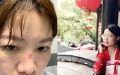 Bác sĩ chống dịch corona ở Vũ Hán: 'Đóng bỉm vì đi vệ sinh là xa xỉ' Bác sĩ chống dịch corona ở Vũ Hán: 'Đóng bỉm vì đi vệ sinh là xa xỉ'