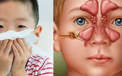 Có thể điều trị viêm xoang bằng cây lá? Có thể điều trị viêm xoang bằng cây lá?