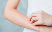 Điều trị viêm mao mạch dị ứng Điều trị viêm mao mạch dị ứng